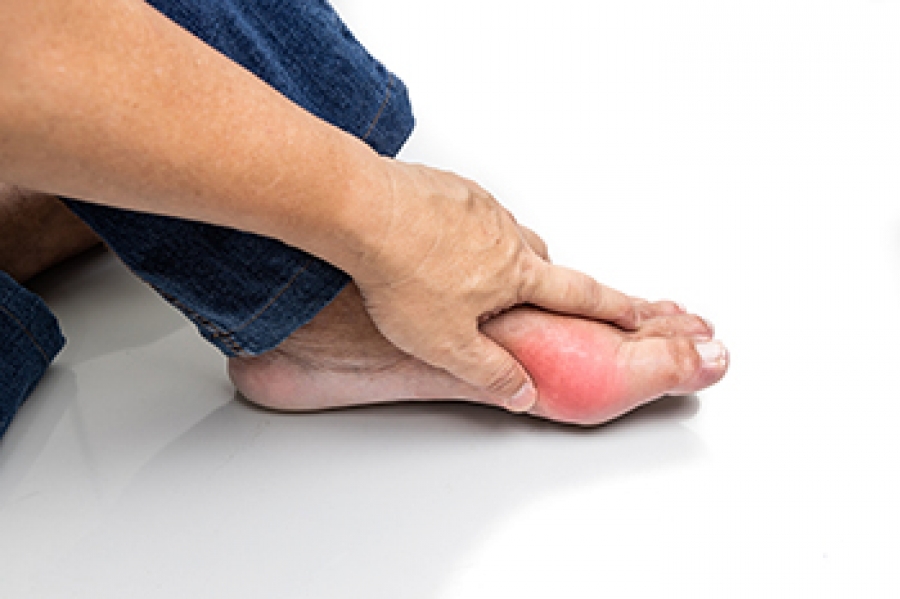 Gout and the Role of Uric Acid